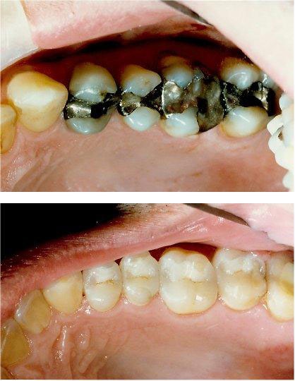 Silver white 20fillings2