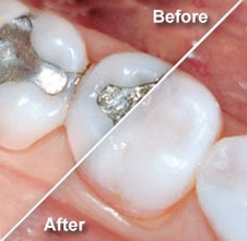 composite fillings