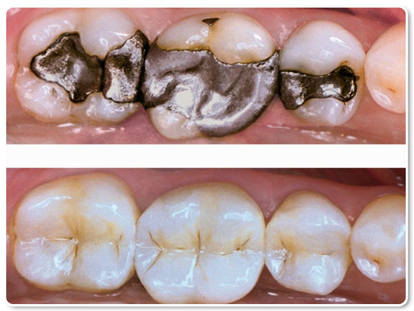 composite resin11